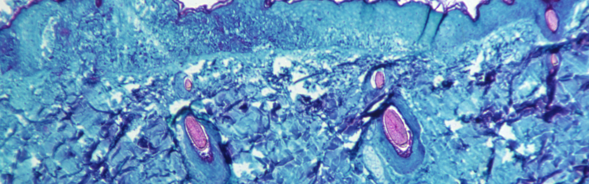 A microscopic image of skin tissue from a monkey infected with monkeypox virus