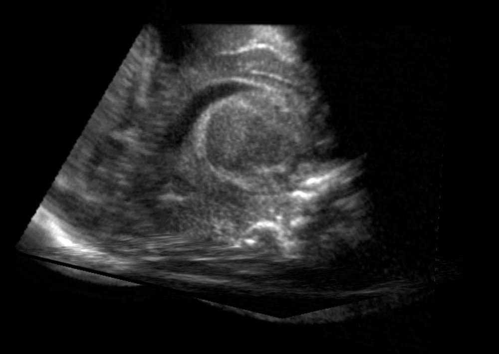 Ultrasound image of a brain's ventricles, a series of blurry, gray lines and patterns in a black background